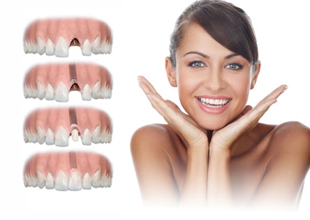 Eksik her diş için 'Bir' implant gerekir mi?